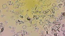 Detail Gambar Uric Acid Dalam Sedimen Urin Nomer 8