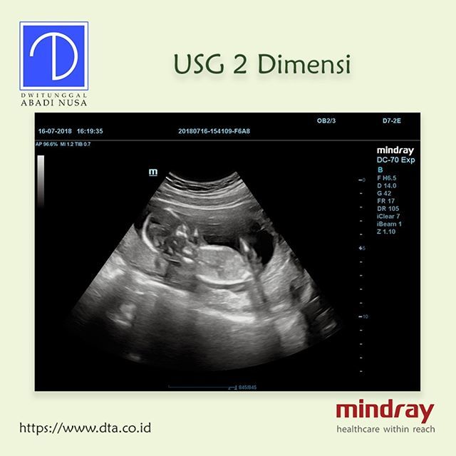 Detail Gambar Usg 2 Dimensi Nomer 30