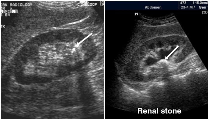 Detail Gambar Usg Batu Ginjal Nomer 2
