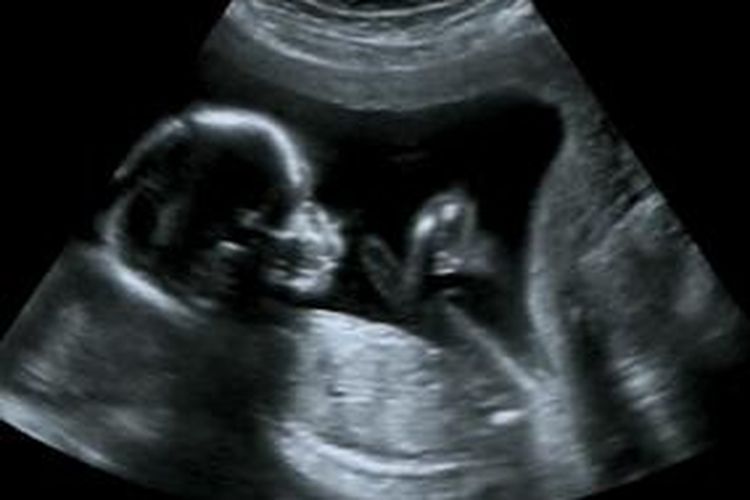 Detail Gambar Usg Bayi Nomer 20