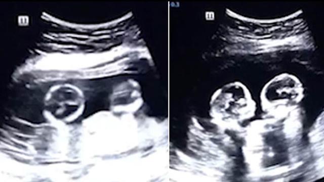 Detail Gambar Usg Bayi Nomer 51
