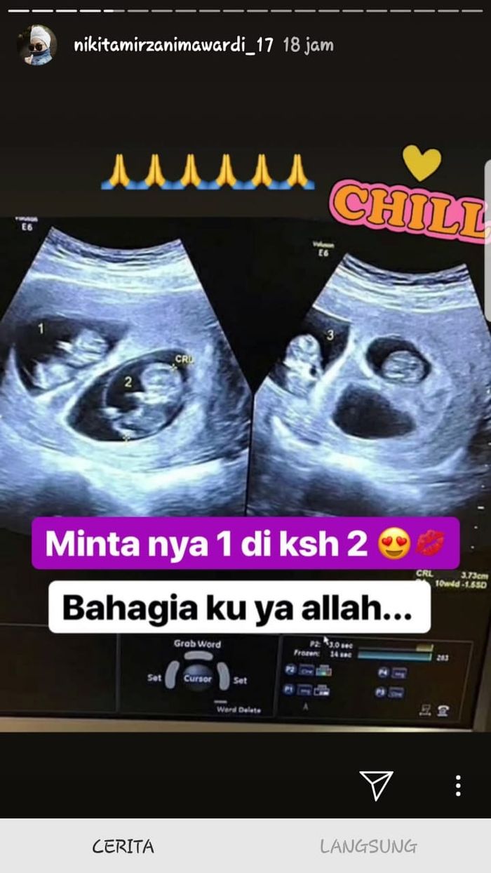 Detail Gambar Usg Bayi Kembar Nomer 9