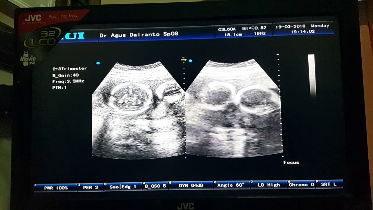 Detail Gambar Usg Bayi Kembar Nomer 13