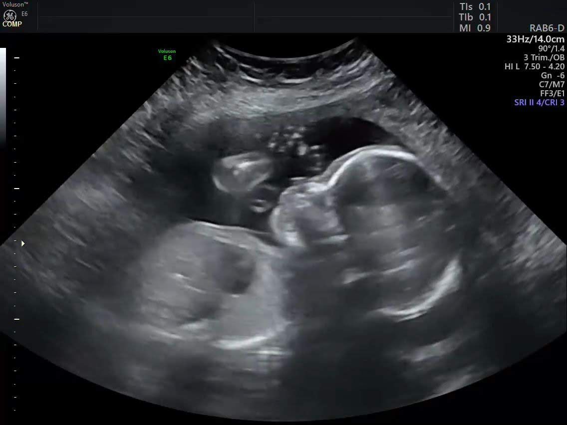 Detail Gambar Usg Bayi Kembar Nomer 15