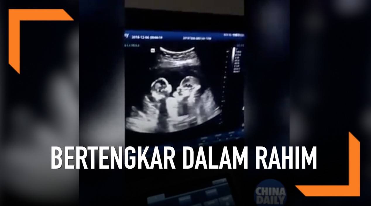 Detail Gambar Usg Bayi Kembar Nomer 25