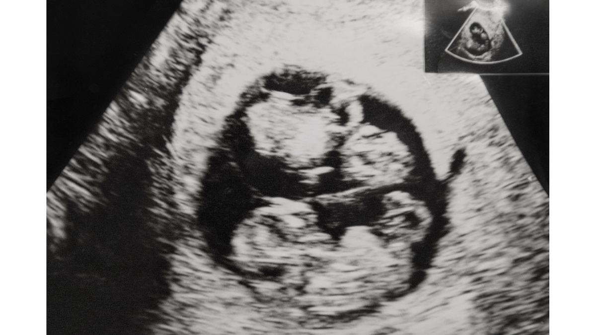Detail Gambar Usg Bayi Kembar Nomer 5