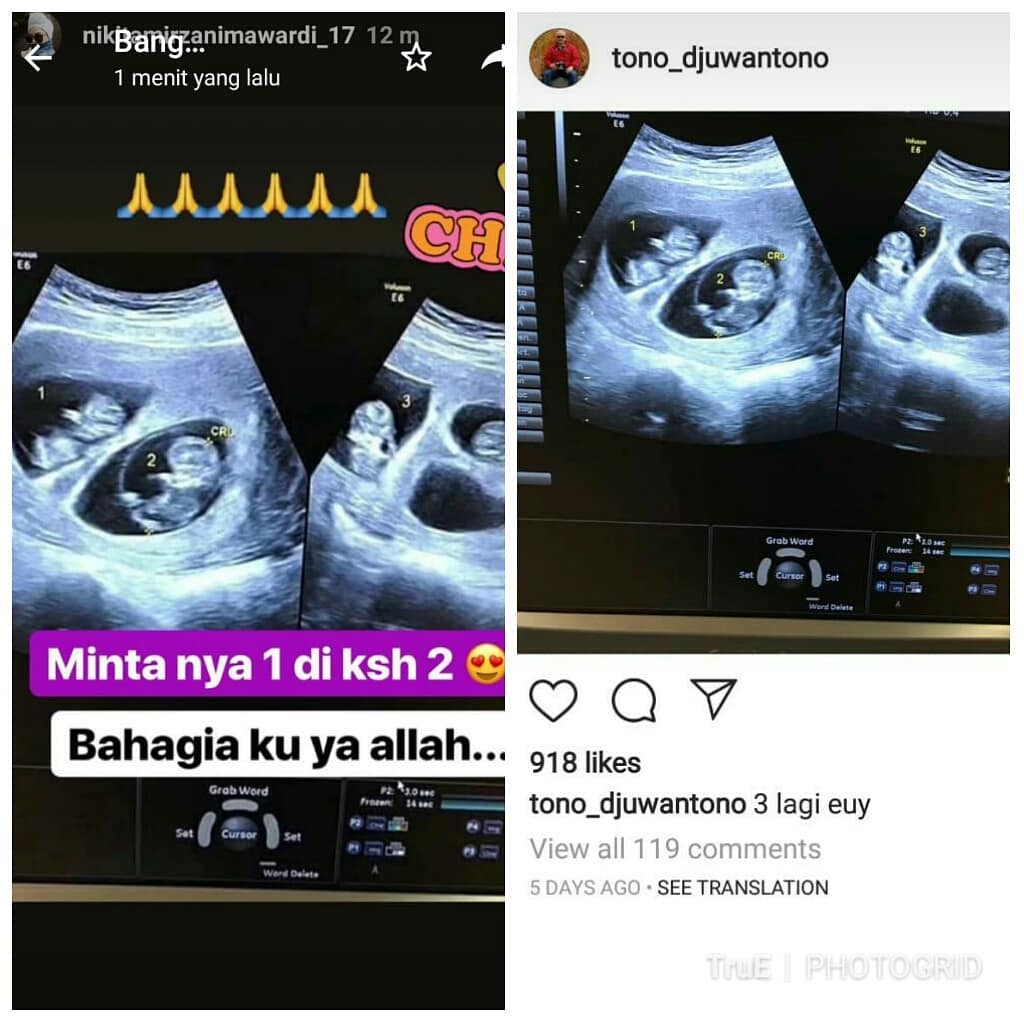 Detail Gambar Usg Bayi Kembar Nomer 50