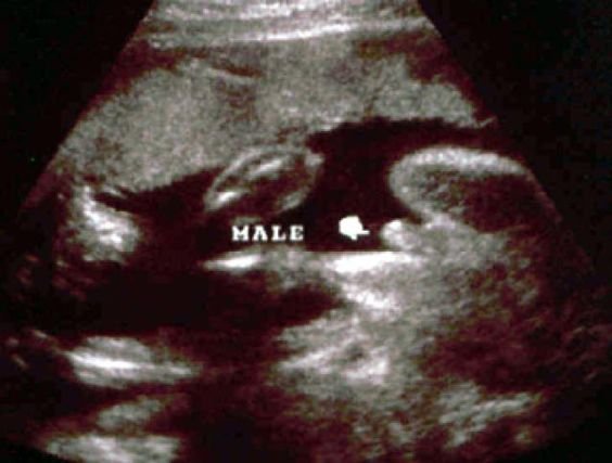 Detail Gambar Usg Bayi Perempuan Nomer 14