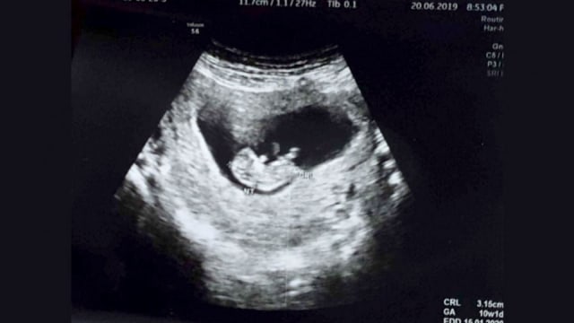 Detail Gambar Usg Bayi Perempuan Nomer 22