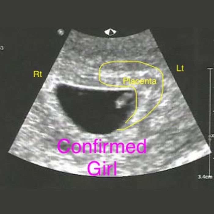 Detail Gambar Usg Bayi Perempuan Nomer 3