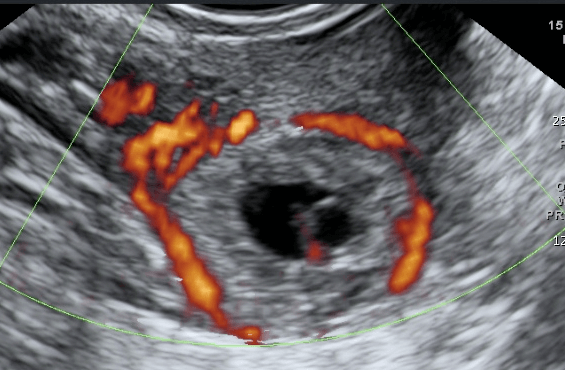 Detail Gambar Usg Hamil Diluar Kandungan Nomer 27