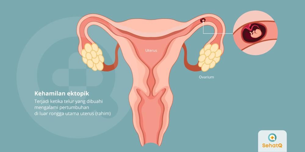 Detail Gambar Usg Hamil Diluar Kandungan Nomer 40