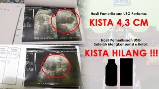 Detail Gambar Usg Kista Nomer 20