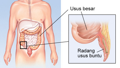 Detail Gambar Usus Buntu Nomer 9