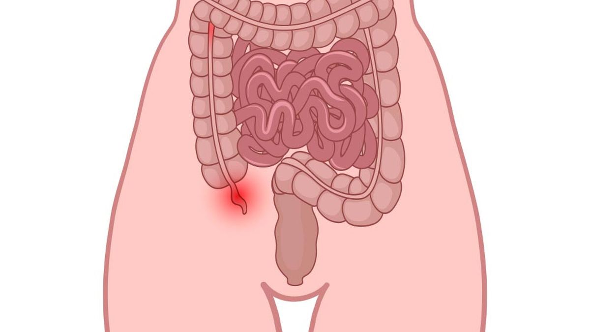 Detail Gambar Usus Buntu Nomer 22