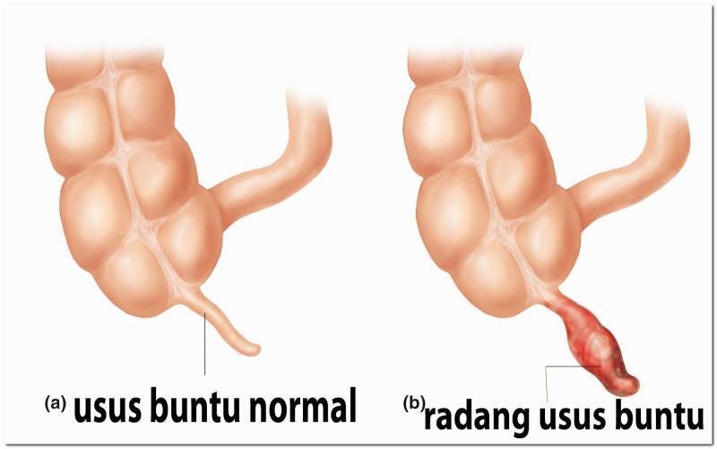 Detail Gambar Usus Buntu Nomer 36