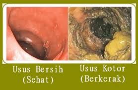 Detail Gambar Usus Kotor Dan Bersih Nomer 2