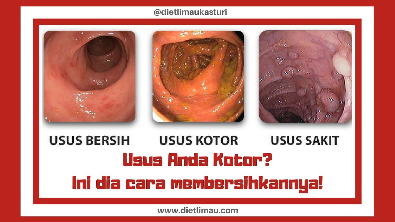 Detail Gambar Usus Kotor Dan Bersih Nomer 49