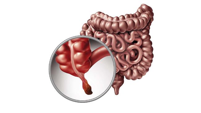 Detail Gambar Usus Turun Nomer 52