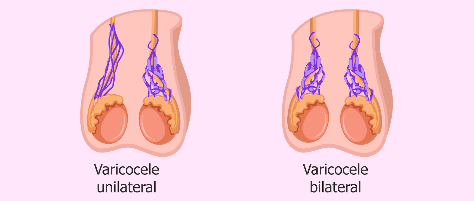 Detail Gambar Varikokel Asli Nomer 28