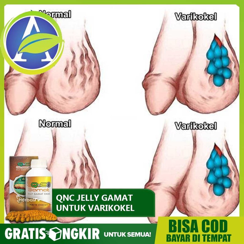 Detail Gambar Varikokel Asli Nomer 5