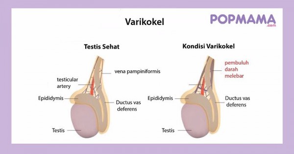 Detail Gambar Varikokel Asli Nomer 47