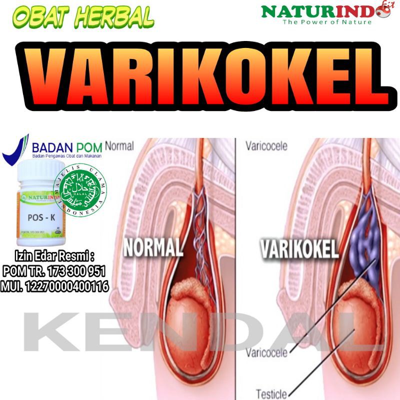 Detail Gambar Varikokel Dan Normal Nomer 17