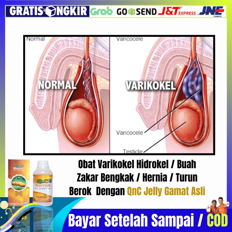 Detail Gambar Varikokel Dan Normal Nomer 28