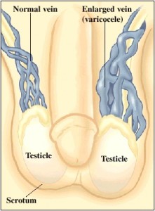 Detail Gambar Varikokel Dan Normal Nomer 53