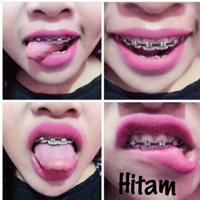 Detail Gambar Warna Behel Yg Cantik Nomer 36