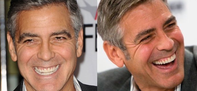 Detail George Clooney Veneers Nomer 18