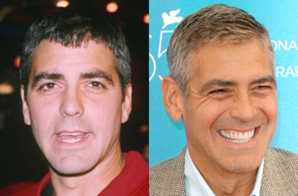 Detail George Clooney Veneers Nomer 3