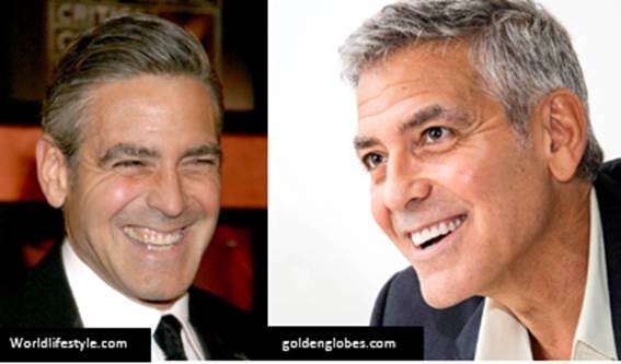 Detail George Clooney Veneers Nomer 54