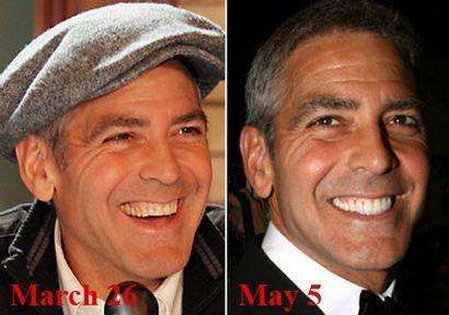 Detail George Clooney Veneers Nomer 9