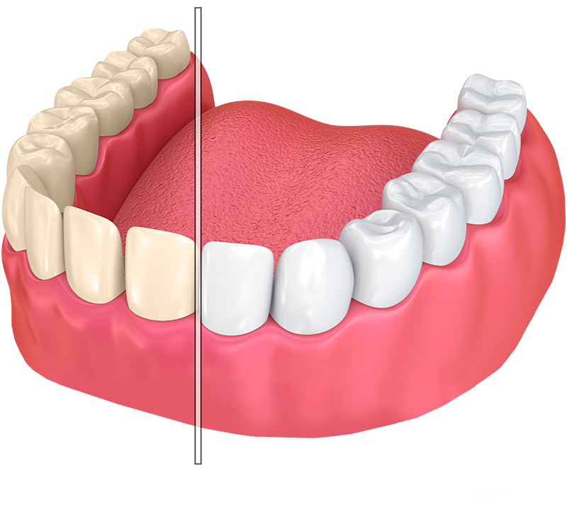 Detail Gigi Palsu Png Nomer 17