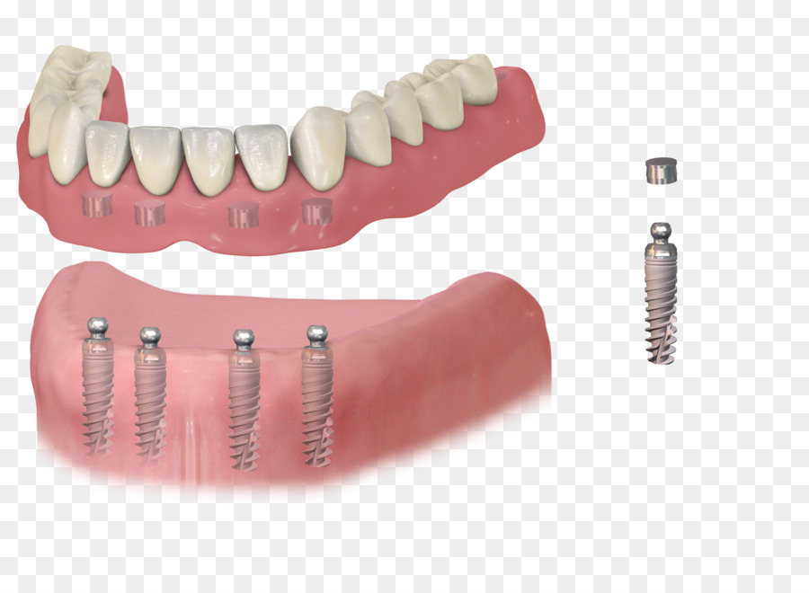 Detail Gigi Palsu Png Nomer 24