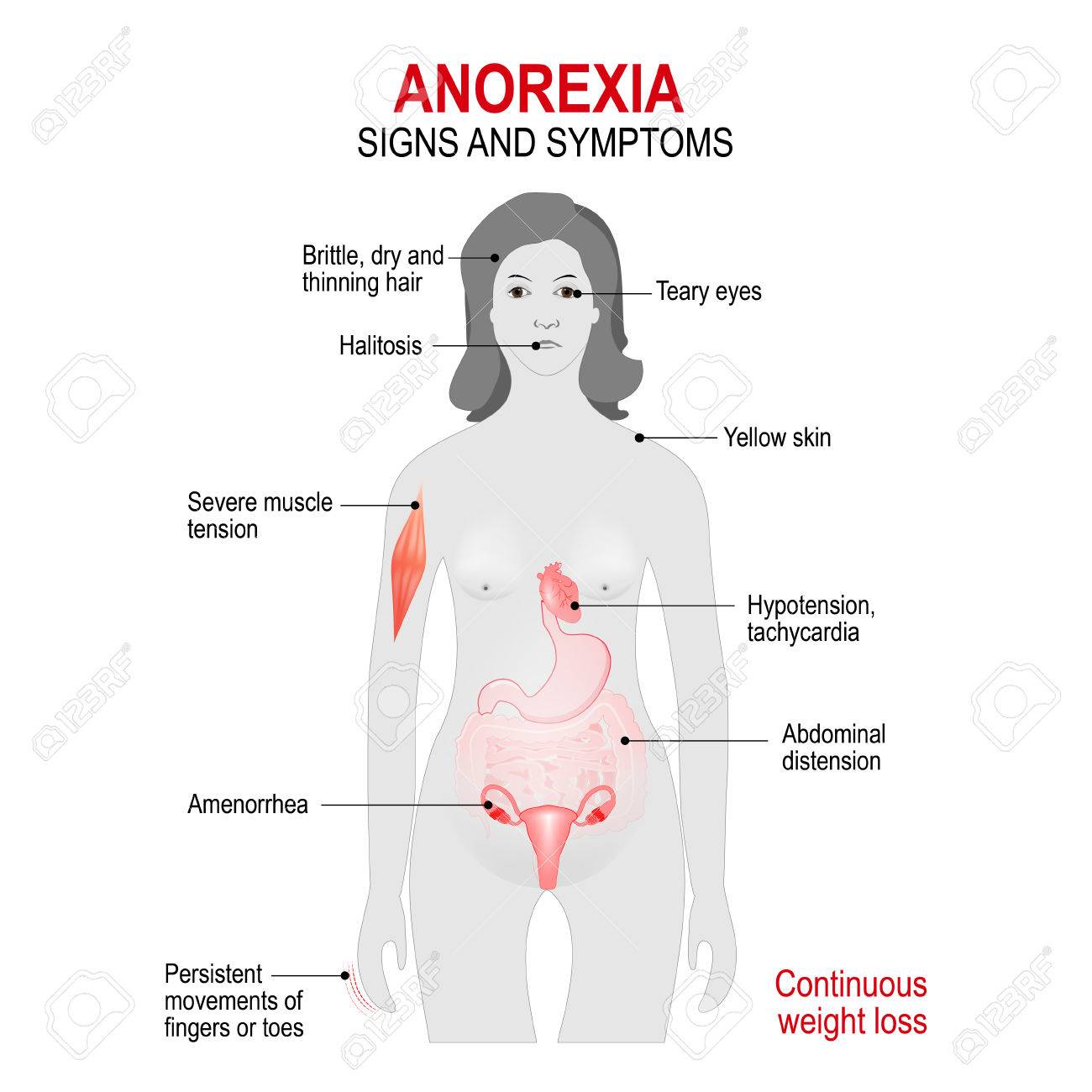 Detail Anorexia Nervosa Infographic Nomer 34