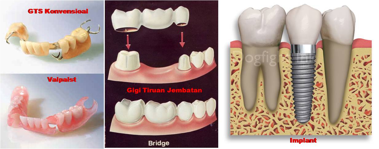 Detail Desain Gigi Tiruan Lengkap Nomer 35