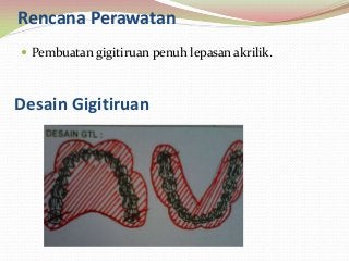 Detail Desain Gigi Tiruan Lengkap Nomer 8