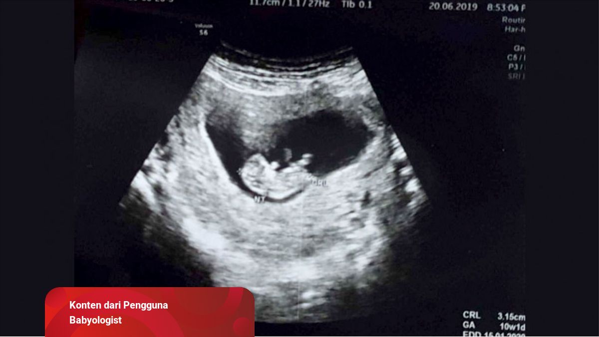 Detail Hasil Gambar Usg Bayi Perempuan Nomer 14