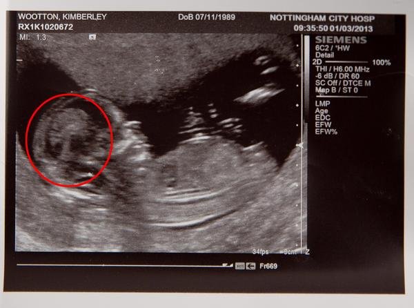 Detail Hasil Gambar Usg Bayi Perempuan Nomer 17