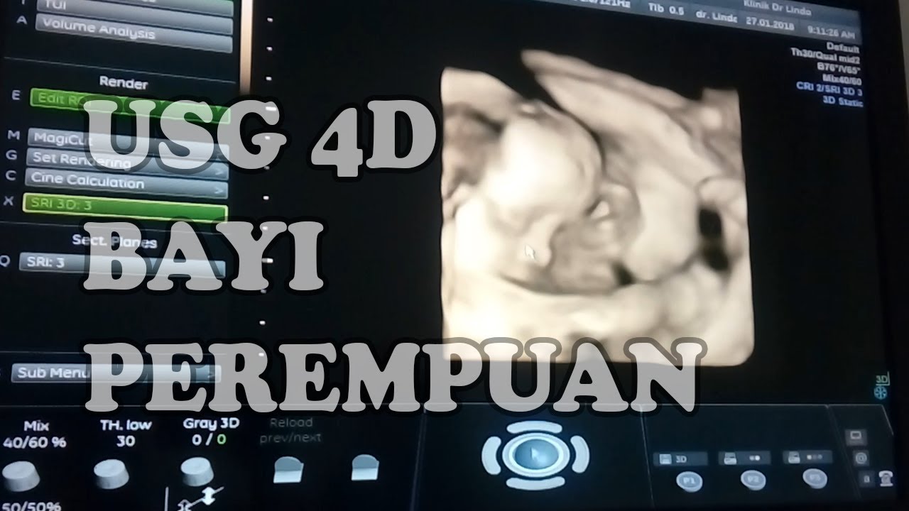 Detail Hasil Gambar Usg Bayi Perempuan Nomer 36