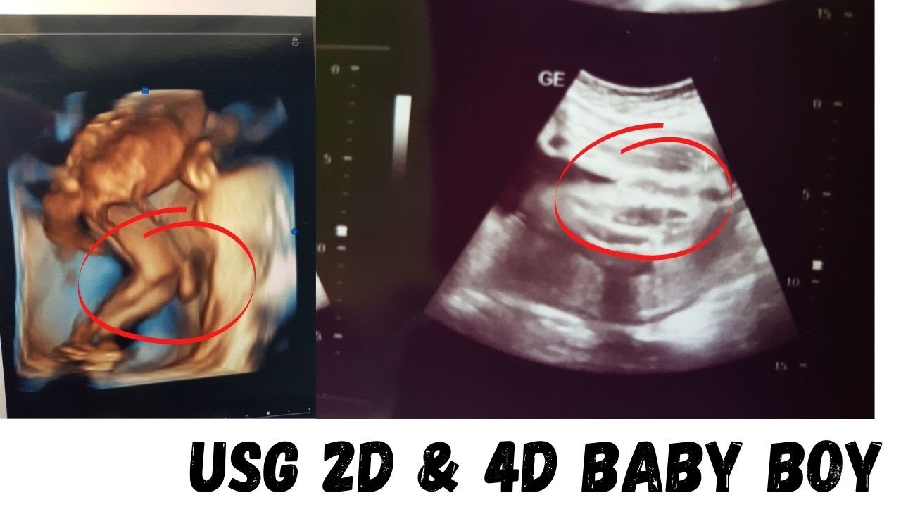 Detail Hasil Gambar Usg Bayi Perempuan Nomer 37