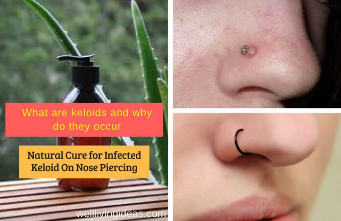 Detail How To Apply Tea Tree Oil To Nose Piercing Nomer 20