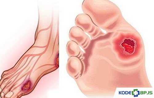 Detail Icd 10 Ganti Perban Nomer 12