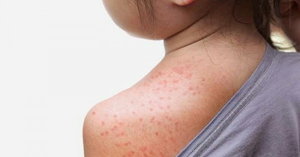 Detail Jenis Alergi Kulit Dan Gambarnya Nomer 33