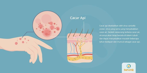 Detail Jenis Herpes Dan Gambarnya Nomer 37