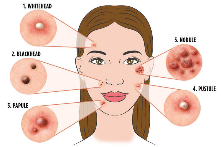 Detail Jenis Jenis Jerawat Dan Gambarnya Nomer 21