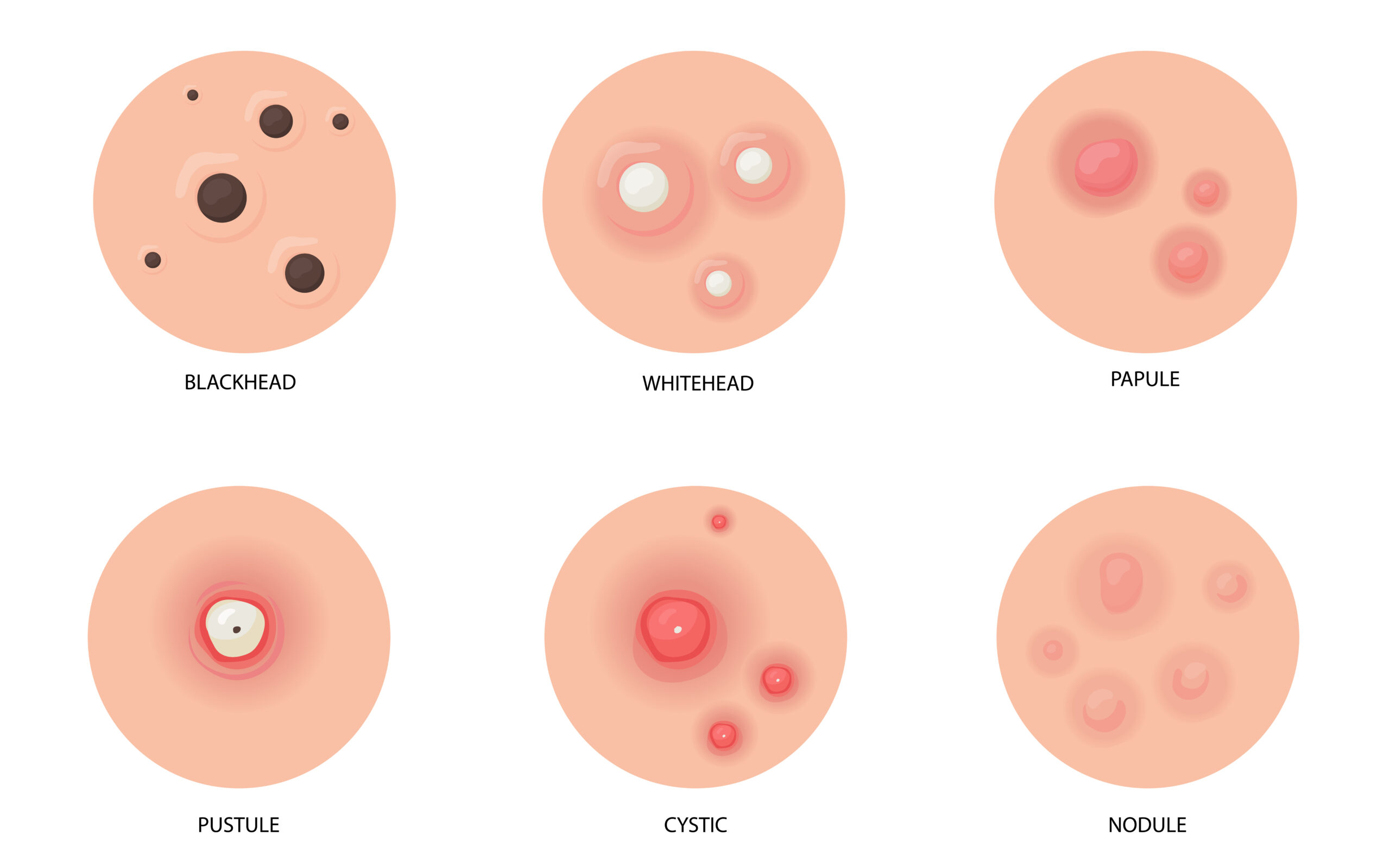Detail Jenis Jenis Jerawat Dan Gambarnya Nomer 10