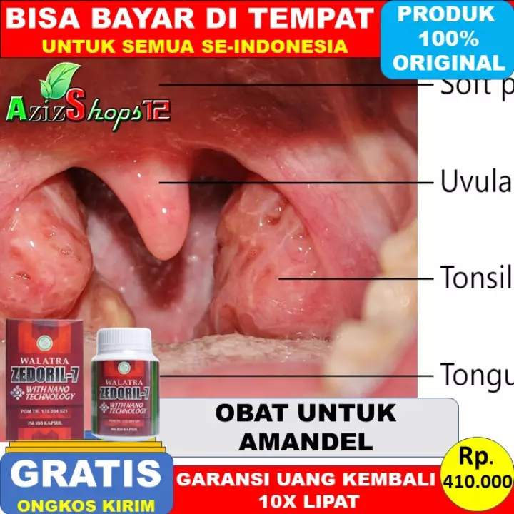 Detail Kanker Tonsil Gambar Nomer 27